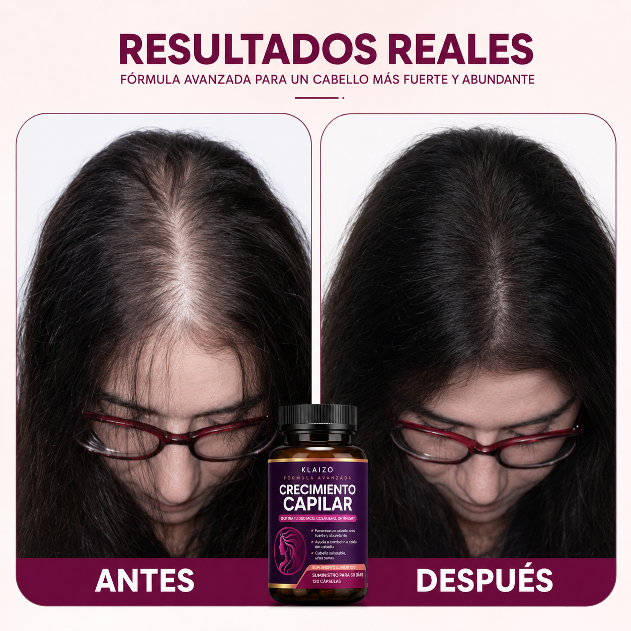 KLAIZO HAIR - Detiene la Caída del Pelo y Estimula el Crecimiento de Raíz.